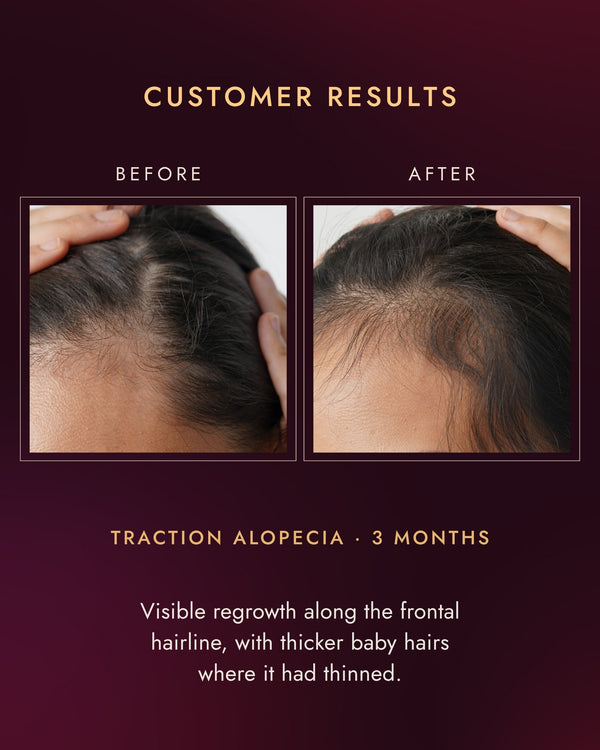 Customer frontal hairline before and after three months, traction alopecia