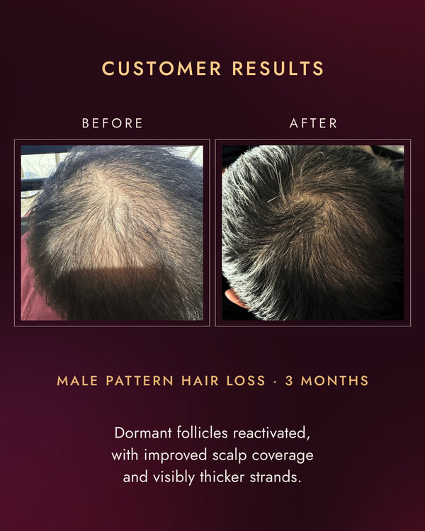 Customer crown before and after three months, male pattern hair loss